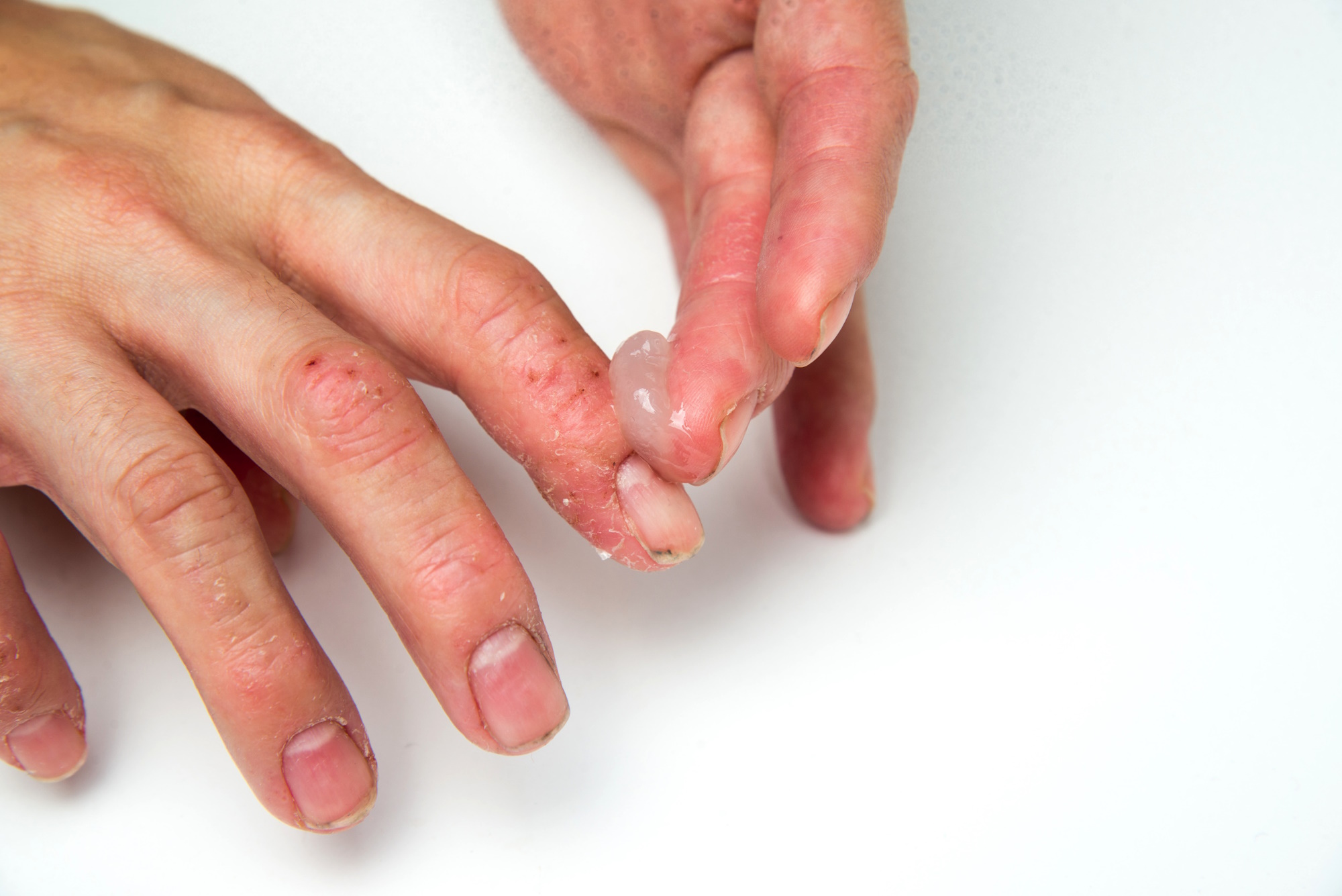 work-related dermatitis background